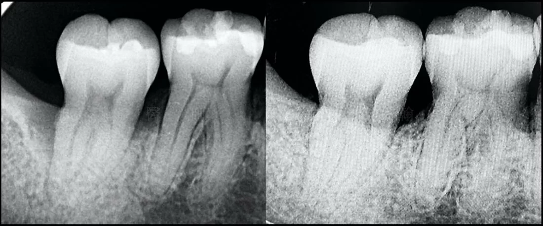 牙周反覆復發 牙周反覆復發