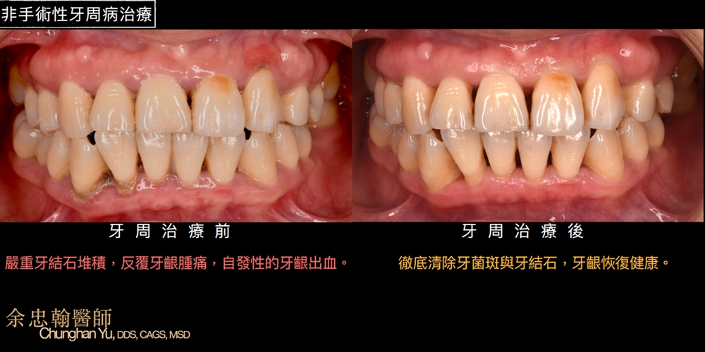 非手術性牙周病治療 非手術性牙周病治療