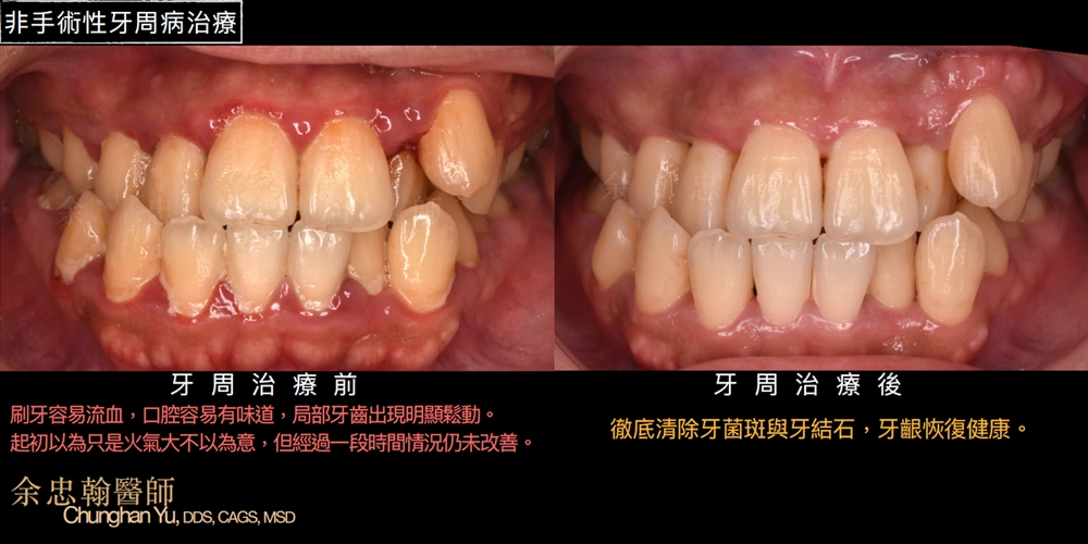 非手術性牙周病治療 非手術性牙周病治療