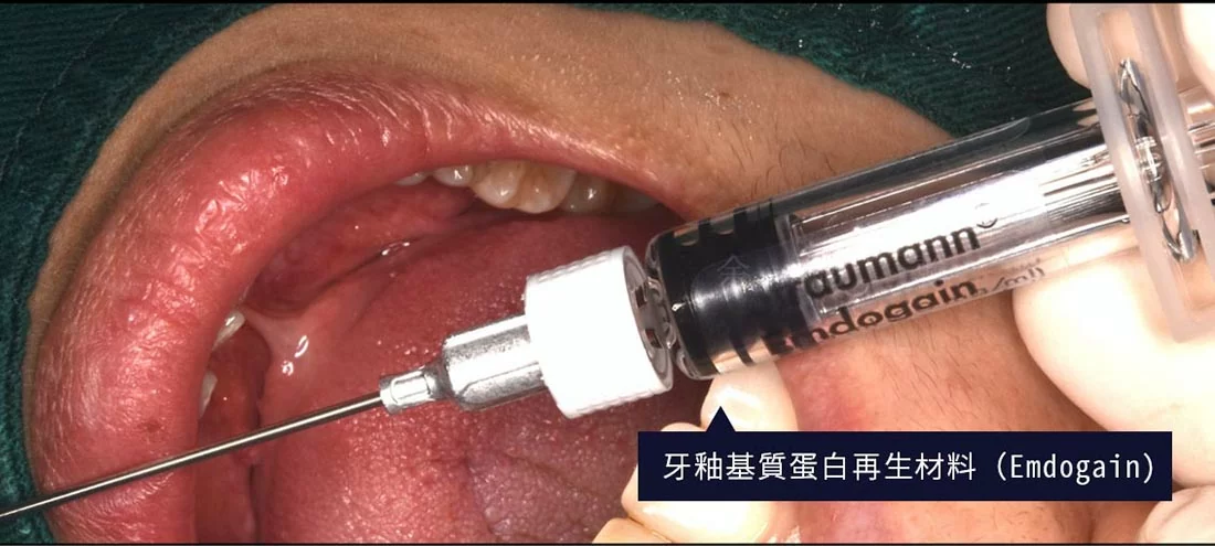 牙周反覆復發 牙周反覆復發