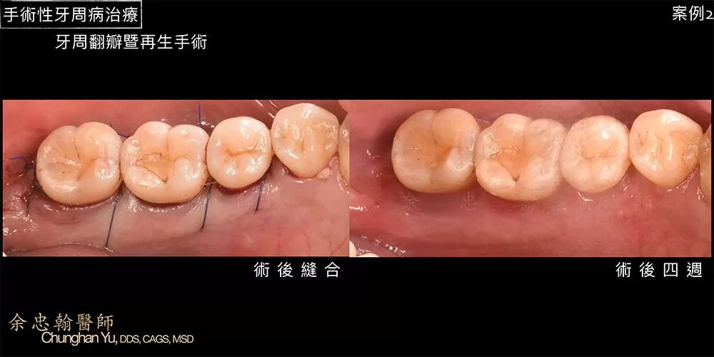 手術性牙周病治療 手術性牙周病治療