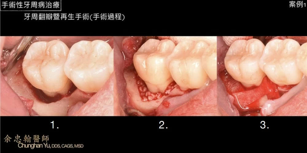 手術性牙周病治療 手術性牙周病治療