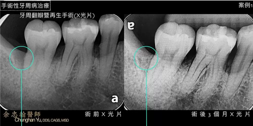 手術性牙周病治療 手術性牙周病治療