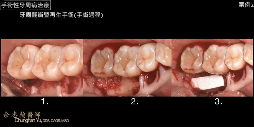 手術性牙周病治療 手術性牙周病治療