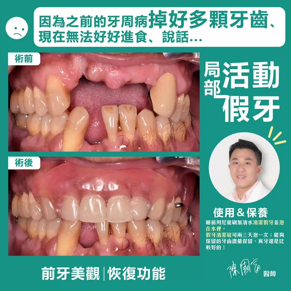 陳國富 | 活動假牙專家