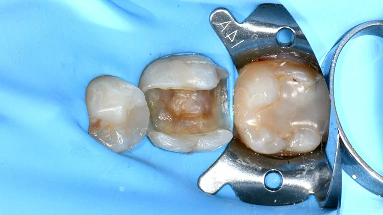 陳雨瑄 | 牙體復形專科