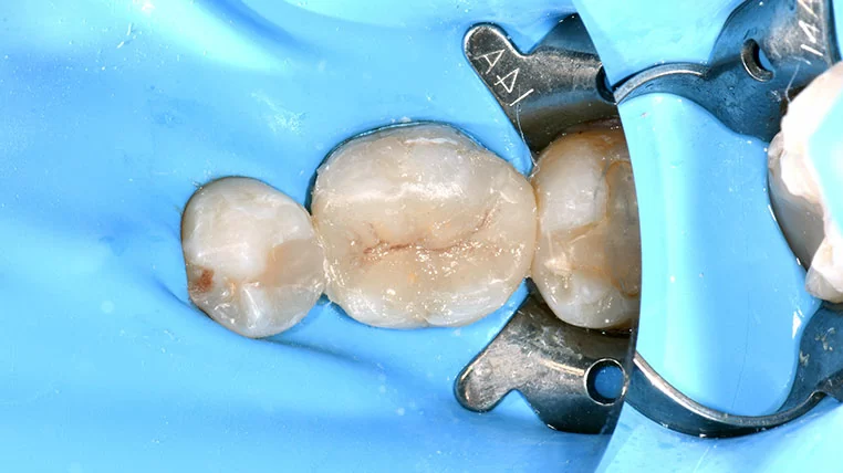 陳雨瑄 | 牙體復形專科