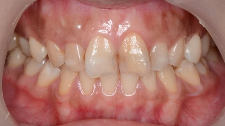 陳雨瑄 | 牙體復形專科