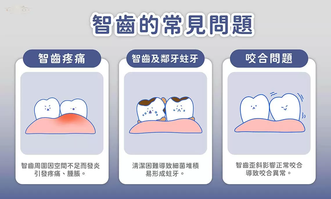 智齒拔除指南:何時與如何進行 智齒拔除指南:何時與如何進行