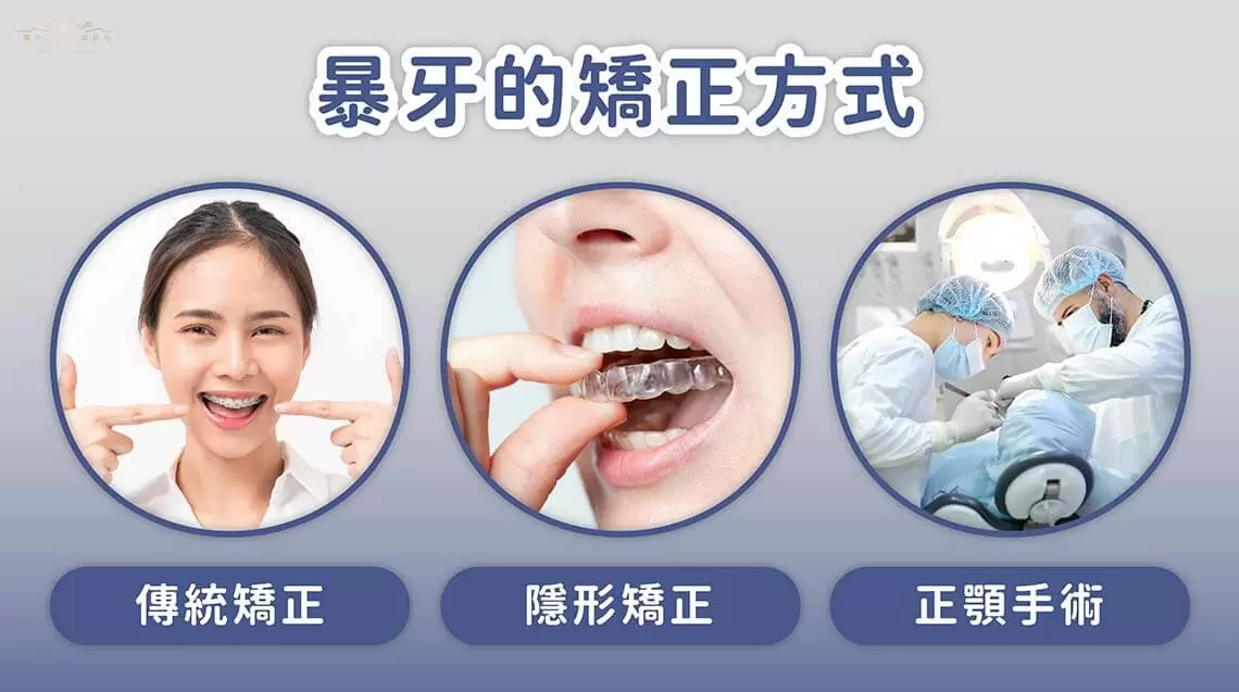 有哪些戰勝暴牙的矯正方法 有哪些戰勝暴牙的矯正方法