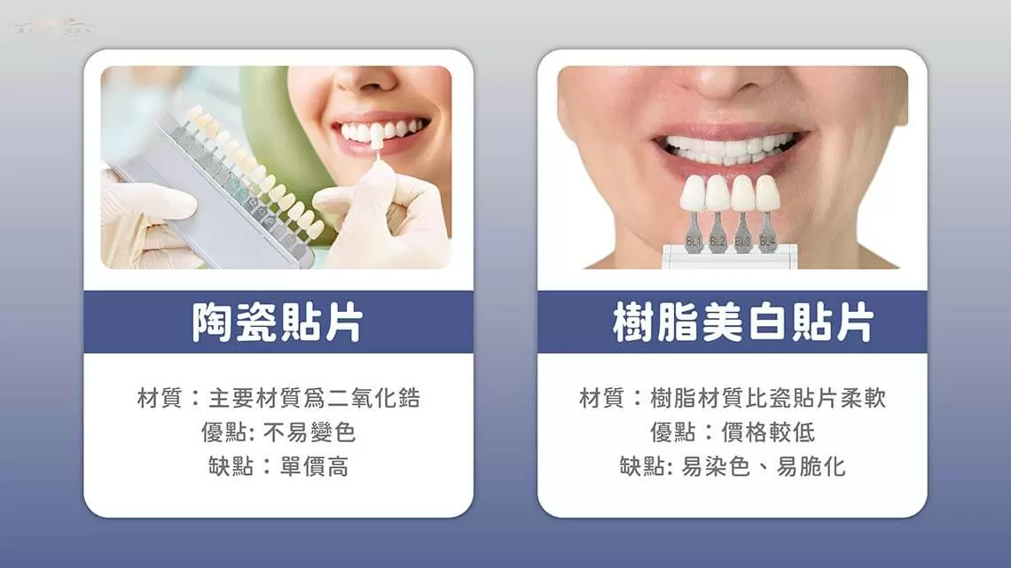 牙齒貼片全面指南:種類、治療過程與費用 牙齒貼片全面指南:種類、治療過程與費用