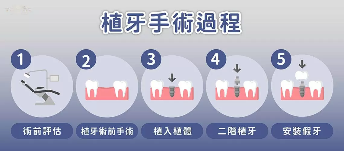 植牙過程解析:從準備到恢復的全面指南 植牙過程解析:從準備到恢復的全面指南