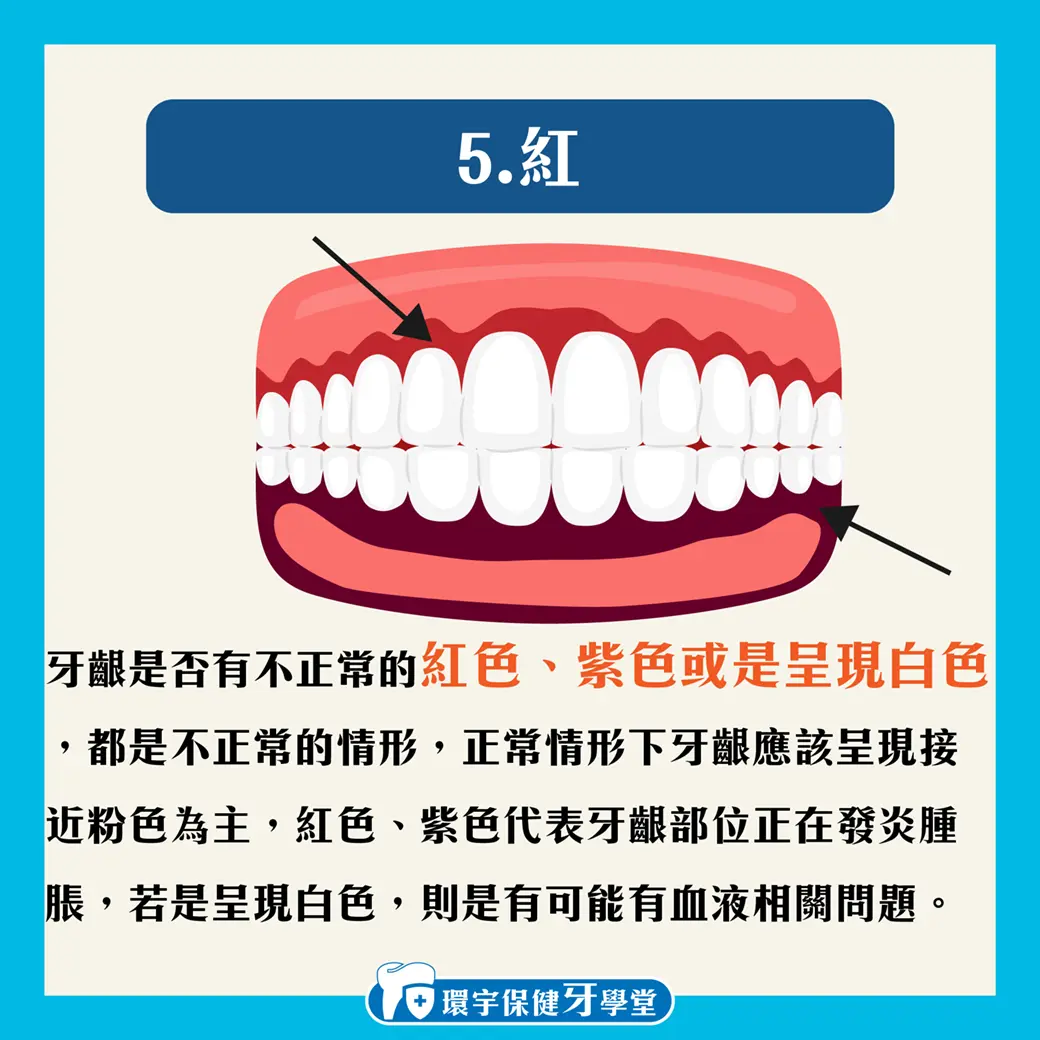 牙齦腫腫的是牙周病嗎?教您如何自我檢測! 牙齦腫腫的是牙周病嗎?教您如何自我檢測!