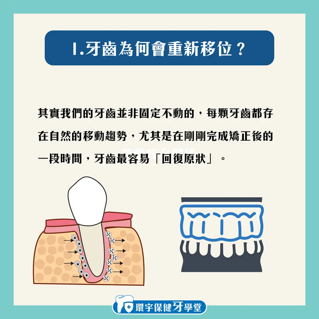 矯正後牙齒又歪了?維持器的重要性不可忽視! 矯正後牙齒又歪了?維持器的重要性不可忽視!