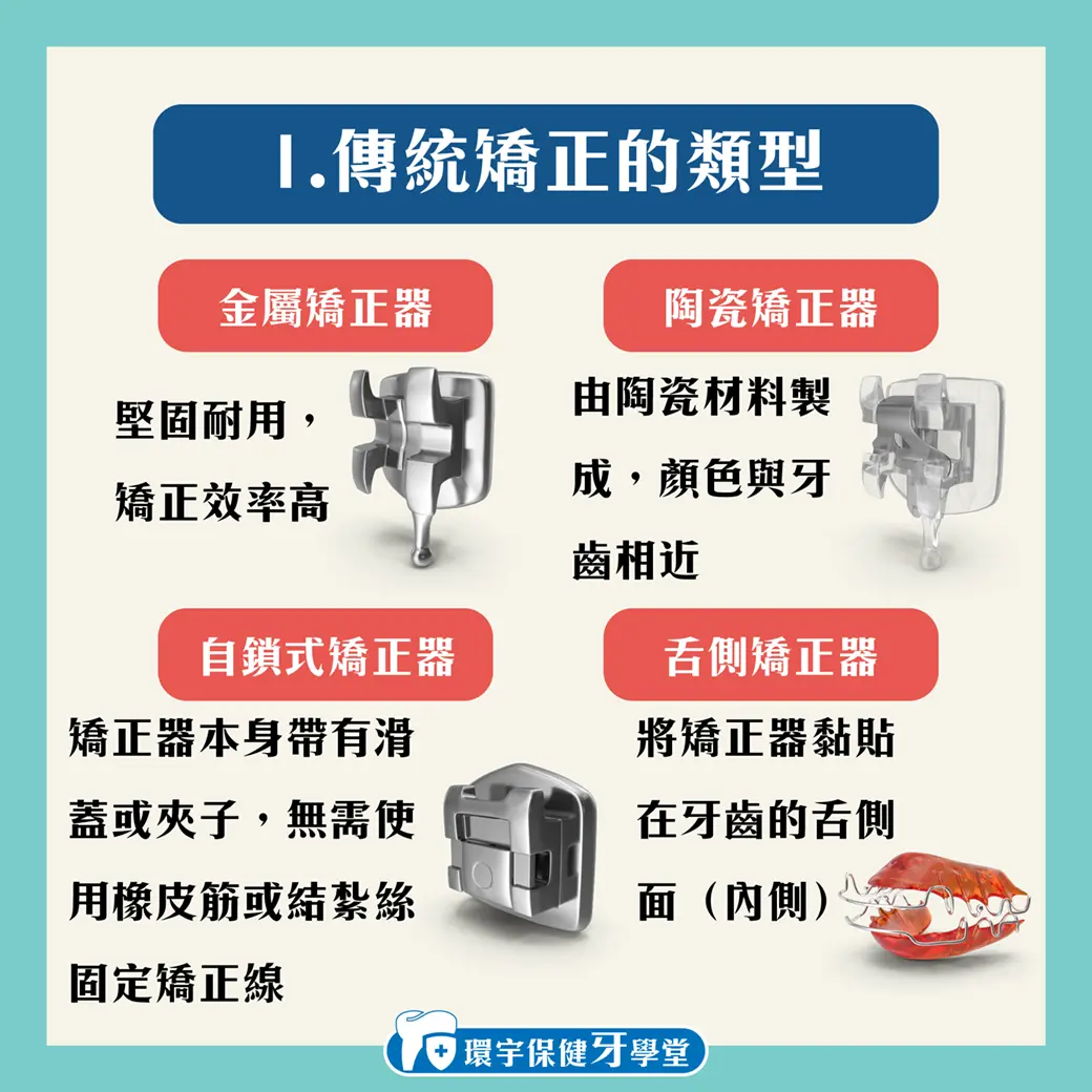 隱形矯正 vs. 傳統矯正:牙齒矯正的選擇指南 隱形矯正 vs. 傳統矯正:牙齒矯正的選擇指南