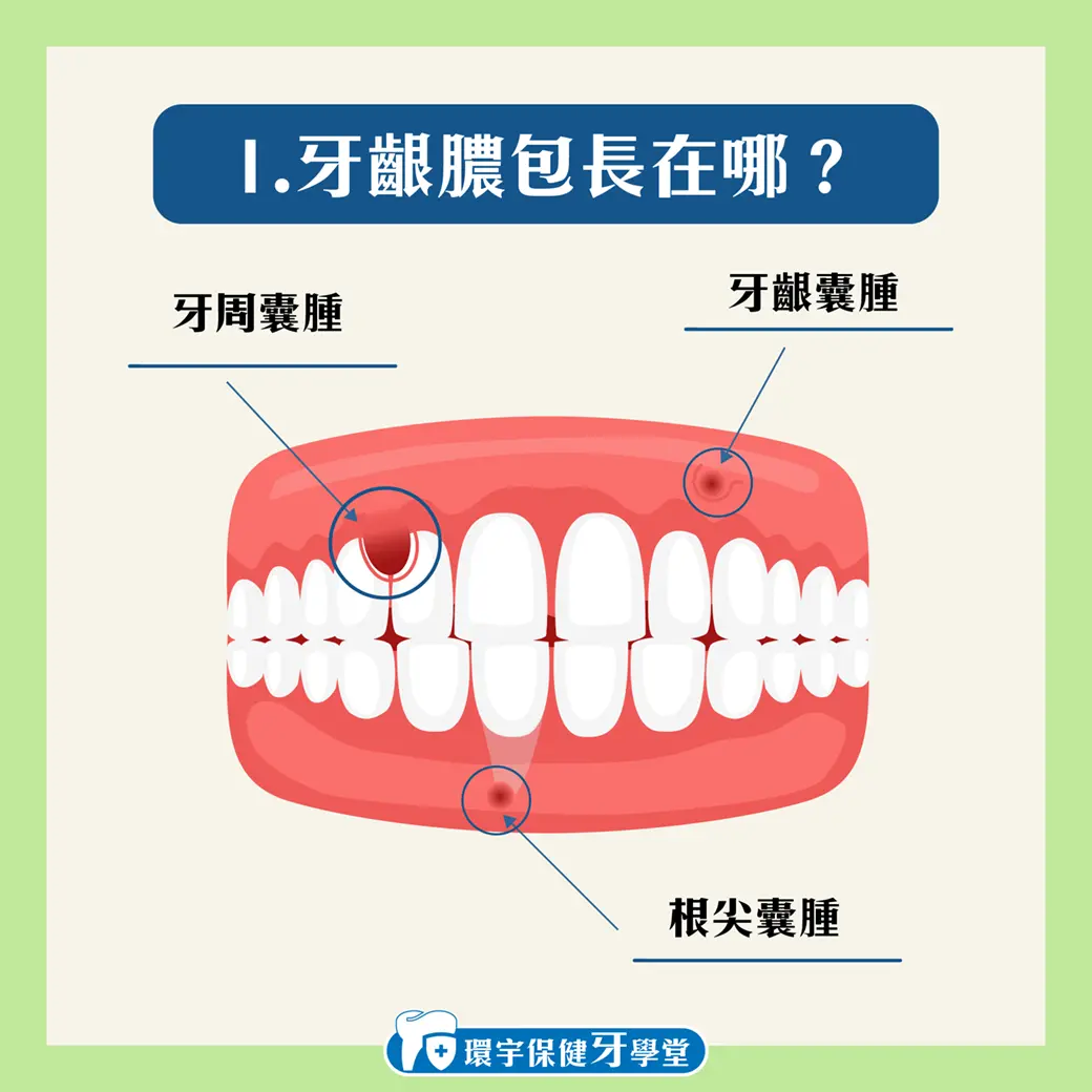 牙齒膿包的迷思破解:真相與誤區 牙齒膿包的迷思破解:真相與誤區