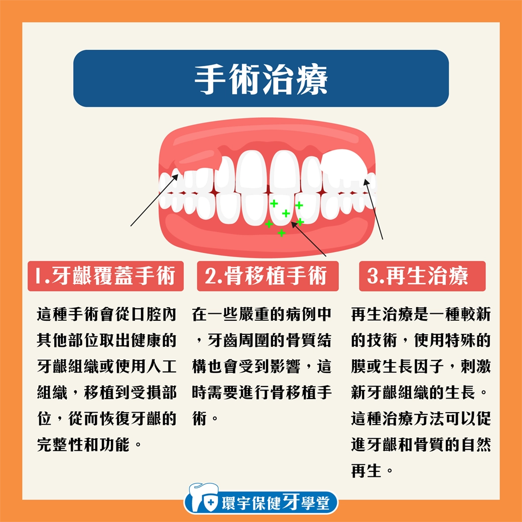 治療牙齦萎縮:手術與非手術選擇的詳細解析 治療牙齦萎縮:手術與非手術選擇的詳細解析