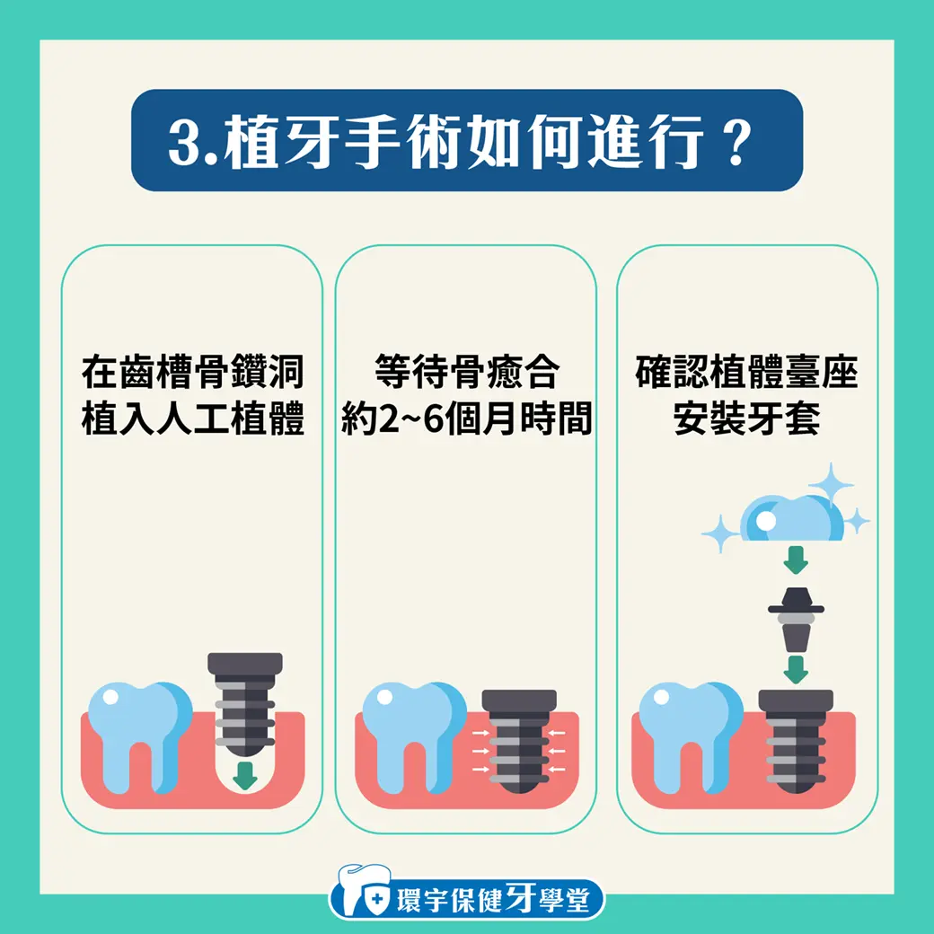 揭開植牙成功與失敗的秘密:流程與因素詳解 揭開植牙成功與失敗的秘密:流程與因素詳解