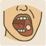 口腔黏膜病灶 口腔潰瘍