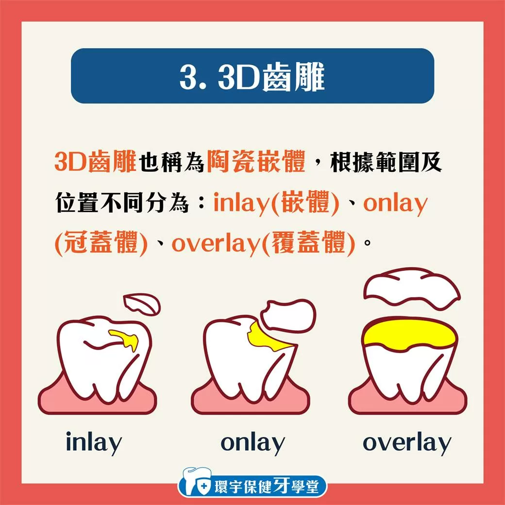 環宇保健牙學堂 - 3D齒雕與樹脂補牙差在哪裡？